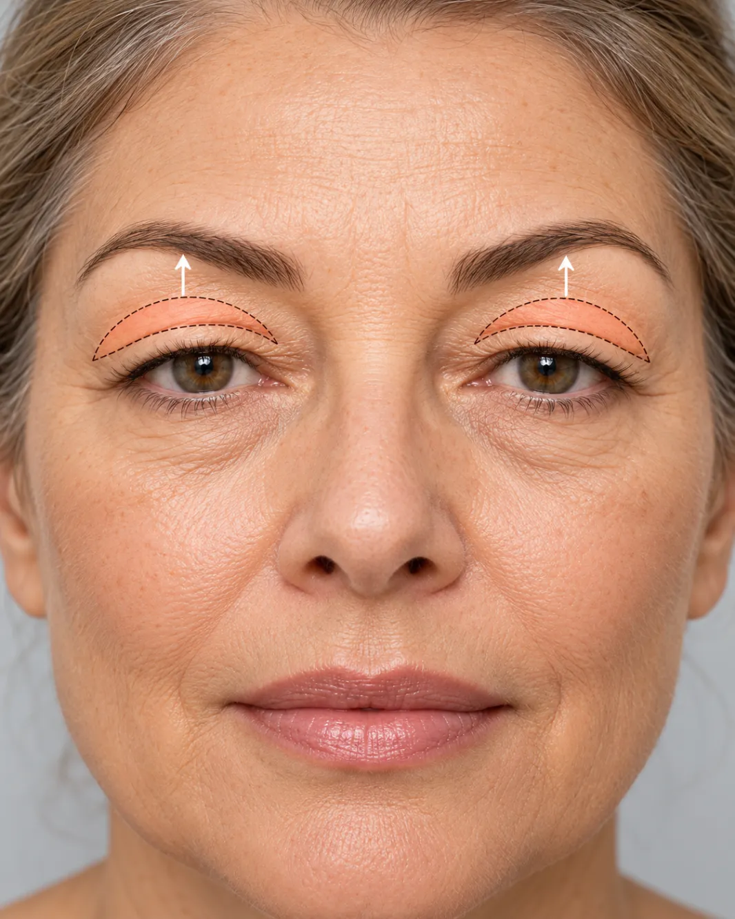 Blefaroplastia superior