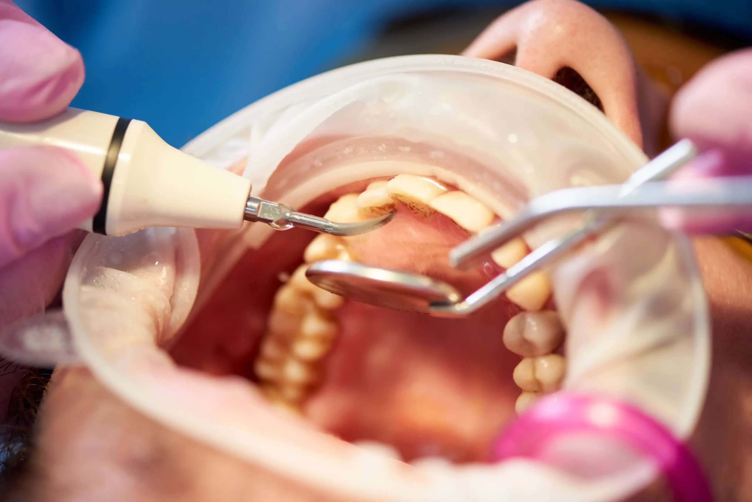 Mantenimiento periodontal