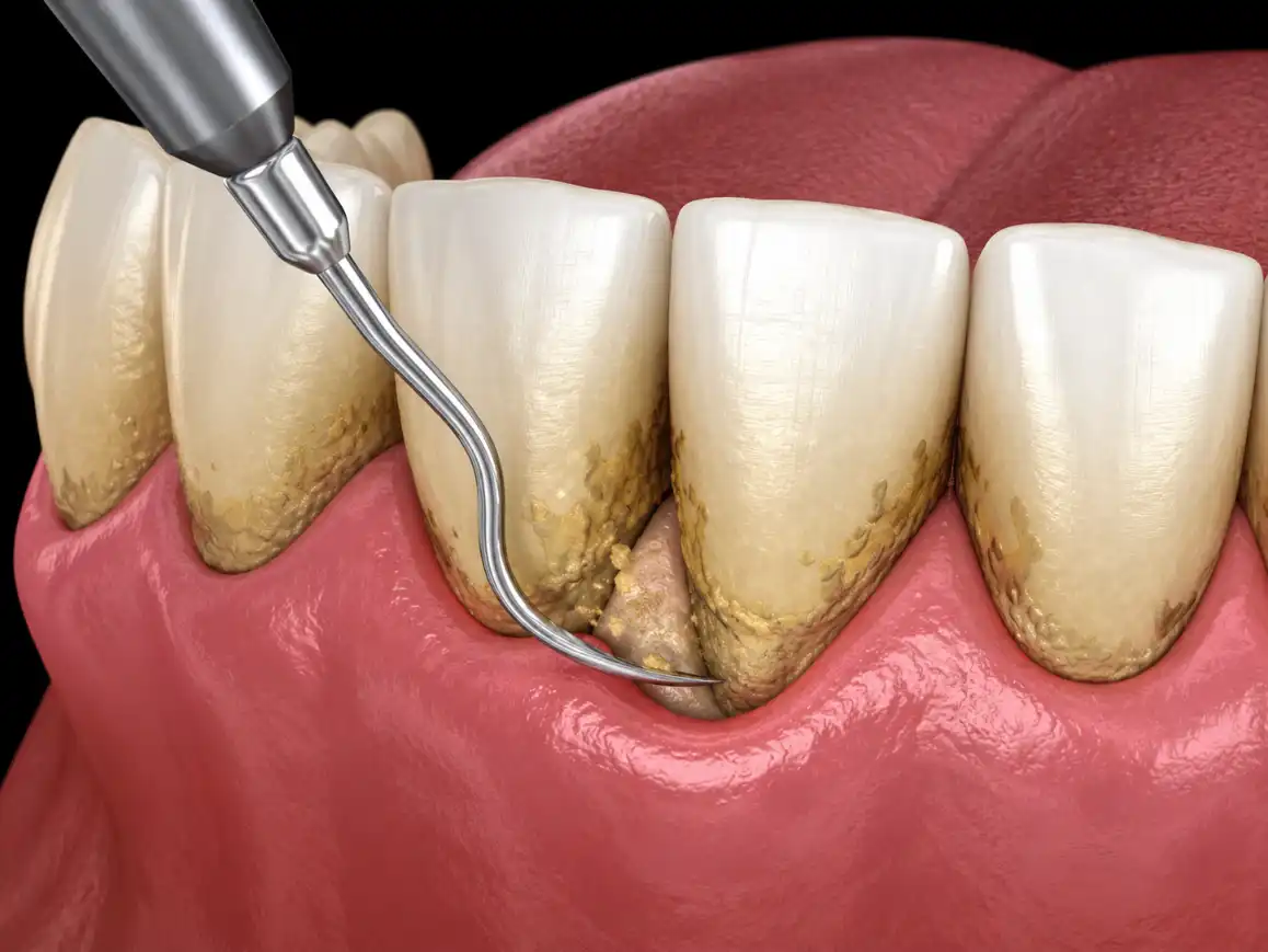 Raspado dental bajo la encía
