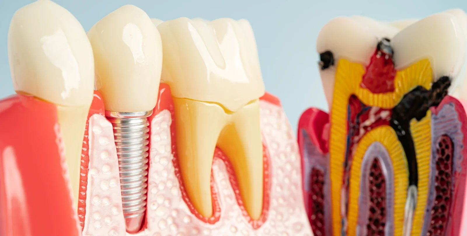 implante dental
